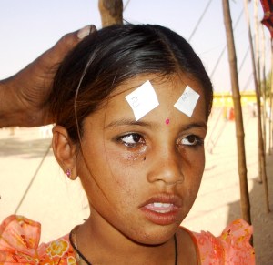 Young girl after treatment 2005-11-17 India II 668